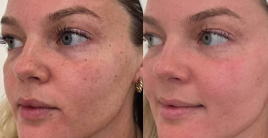 BBL HEROic before and after treatment result