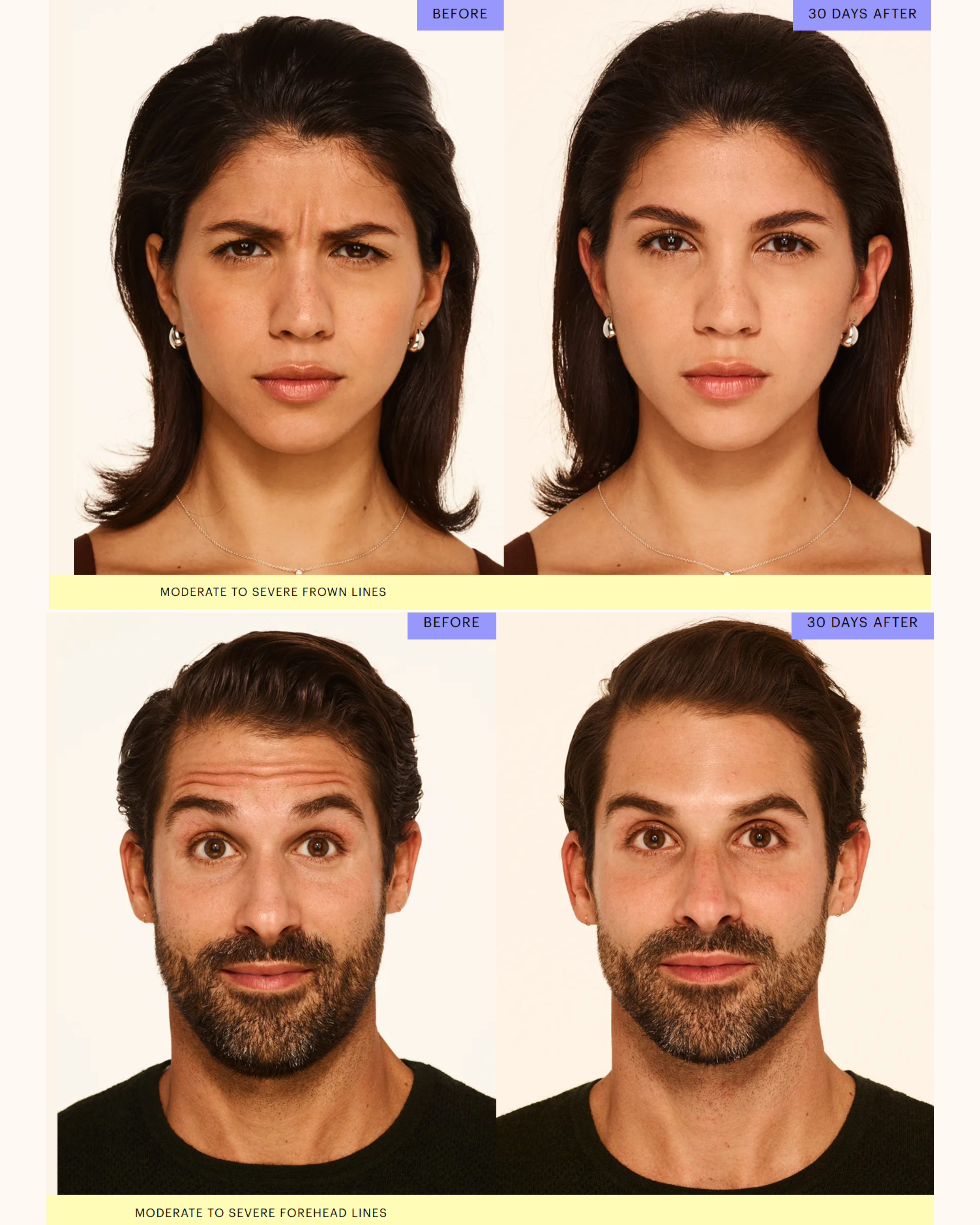 Botox before and after