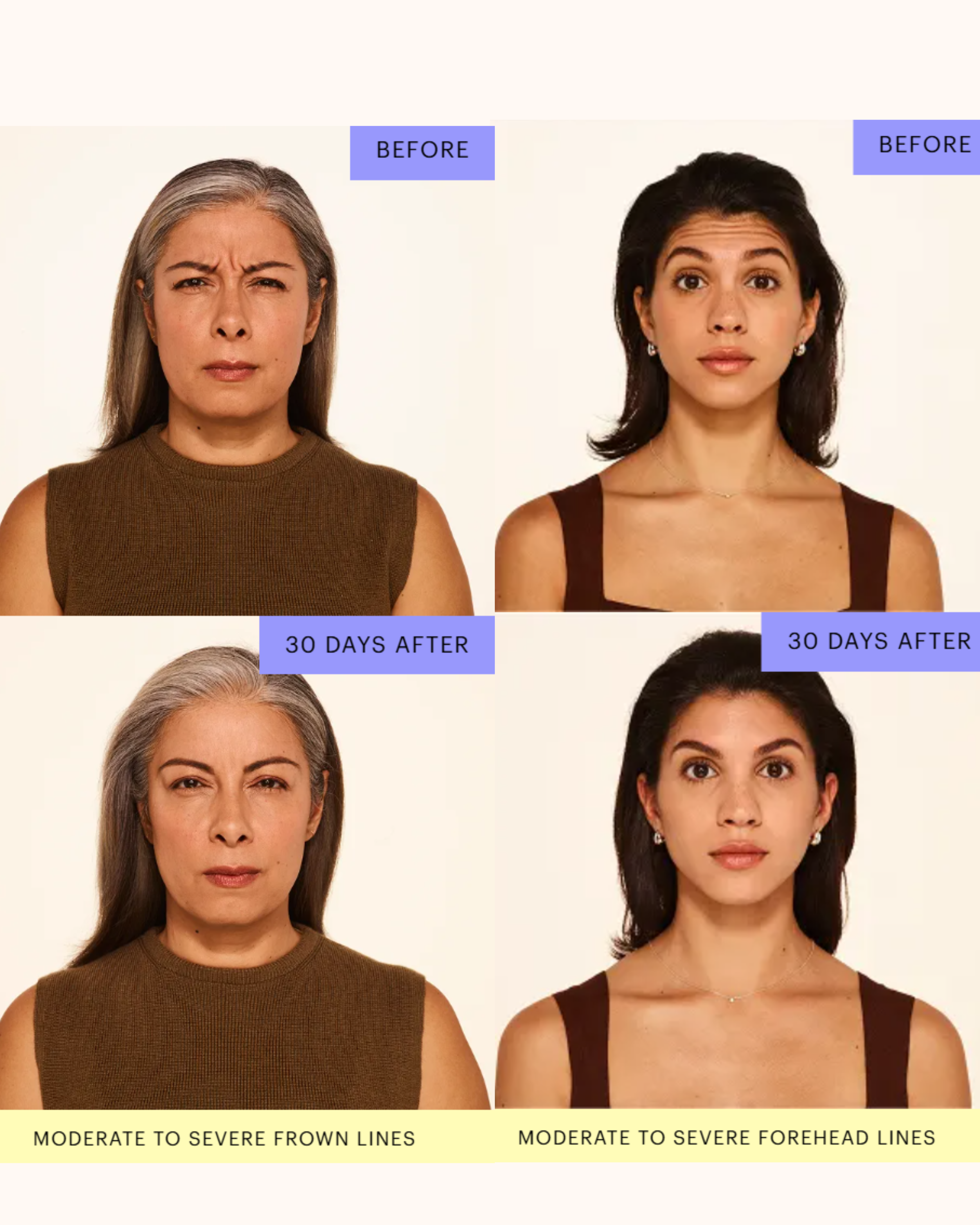 Botox transformation results