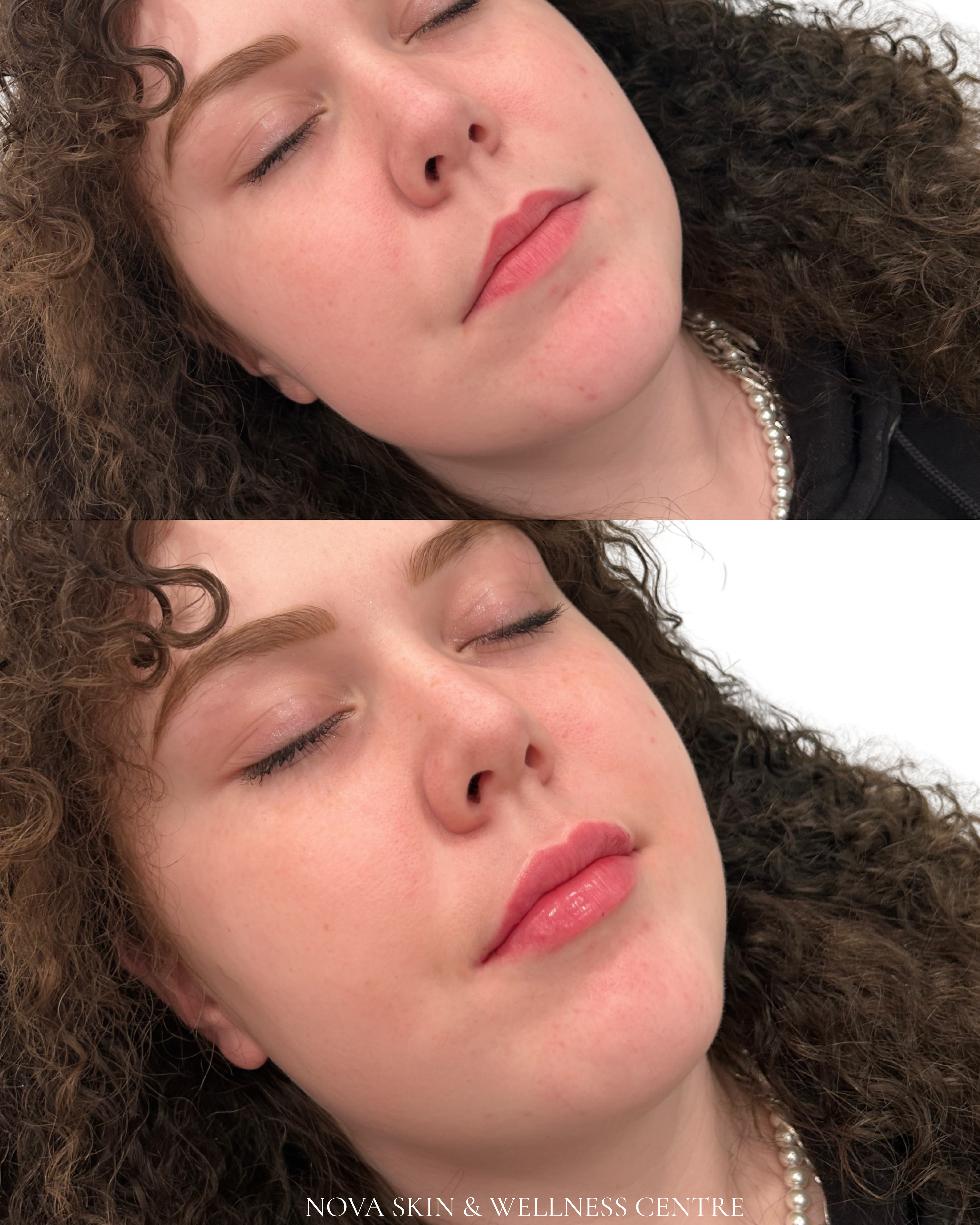 Lip filler before and after
