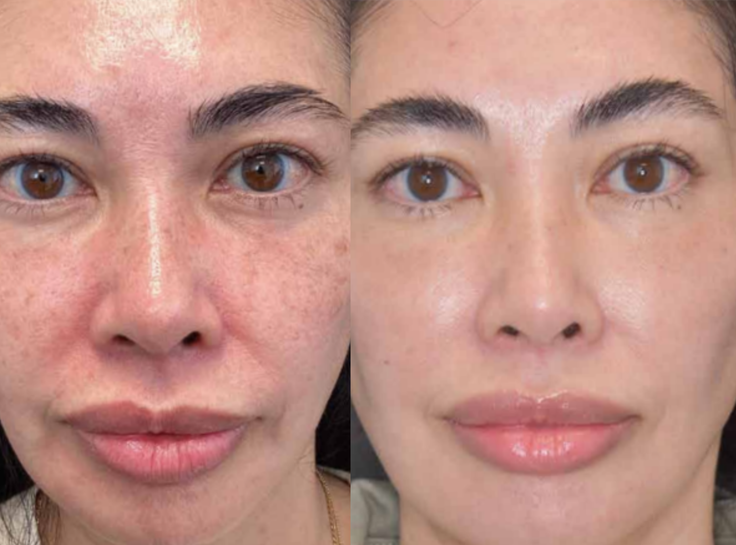 MOXI laser skin resurfacing before and after