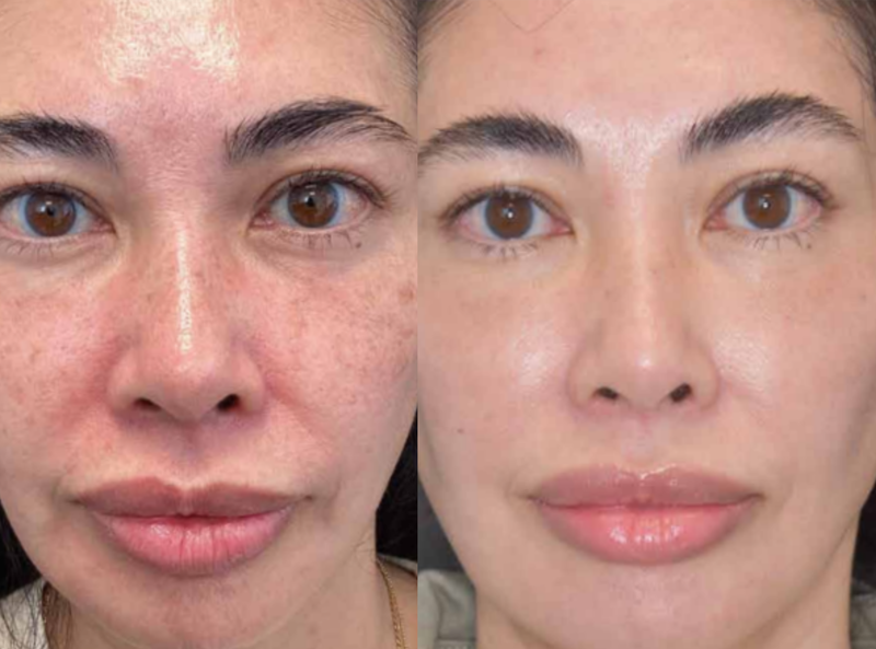 Moxi laser resurfacing before and after