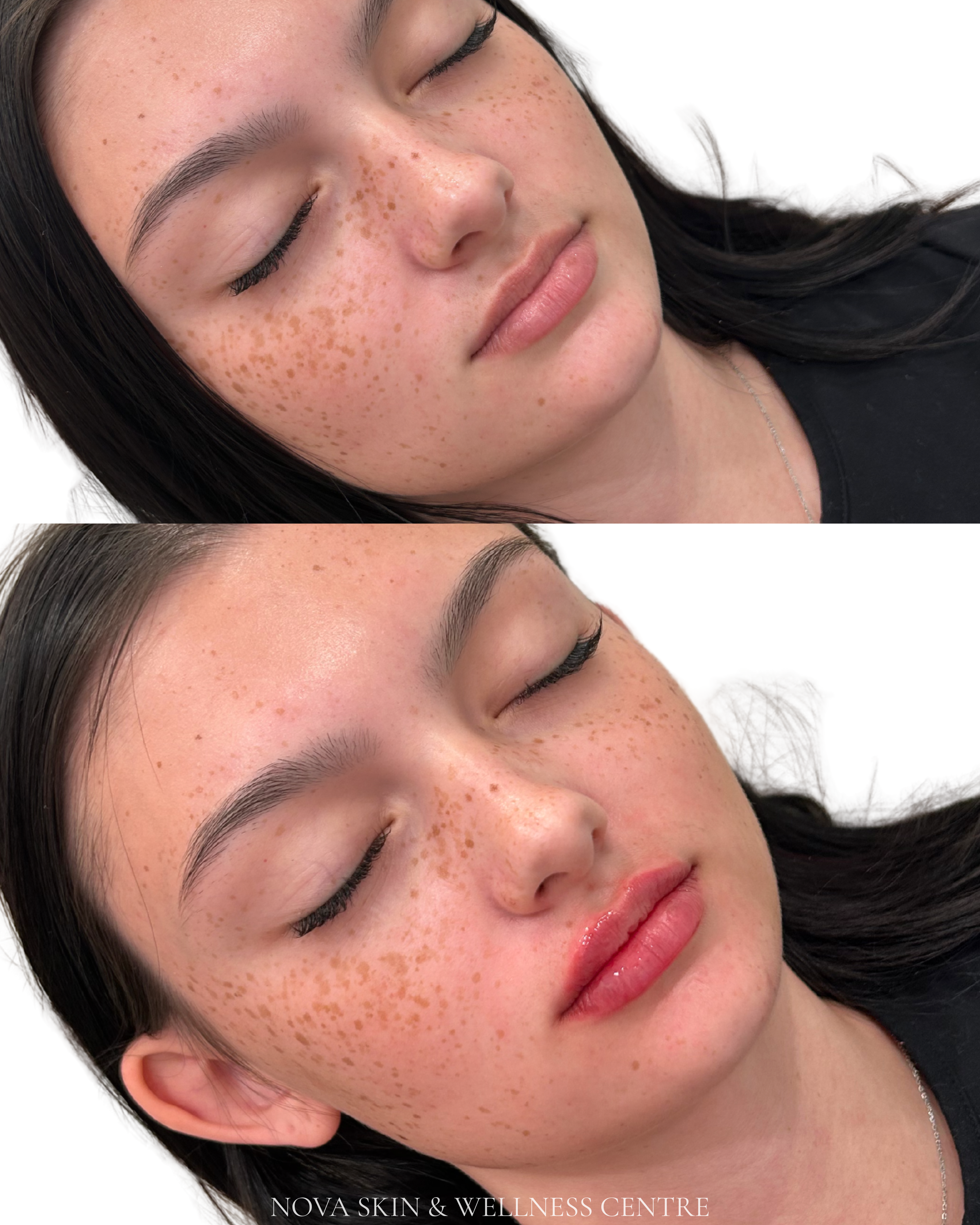 Mini lip before and after