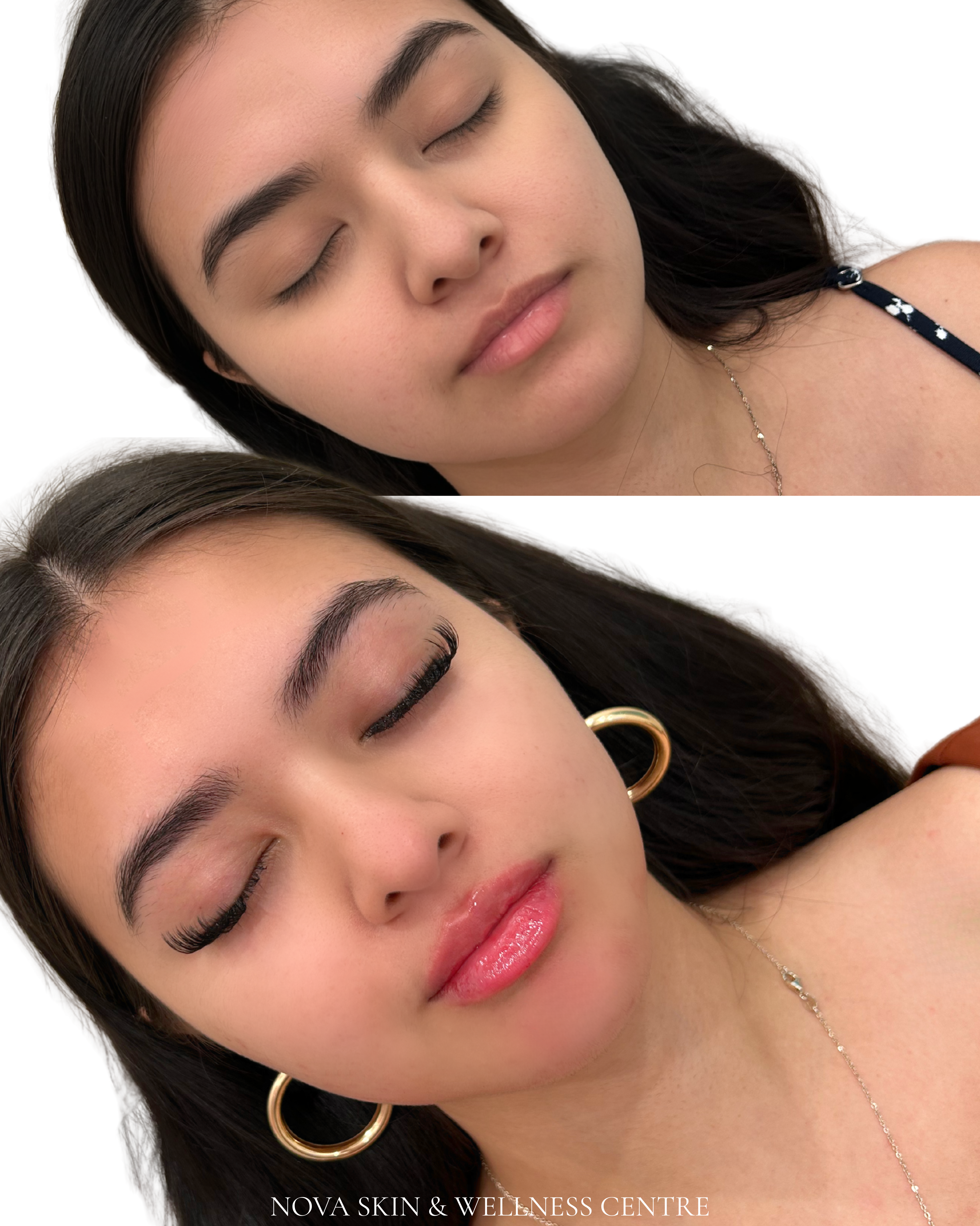 Mini lip transformation
