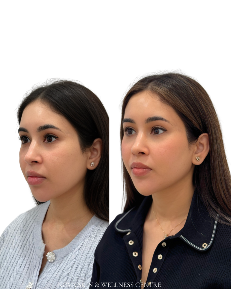 Nova Liquid Lift facial balancing before and after