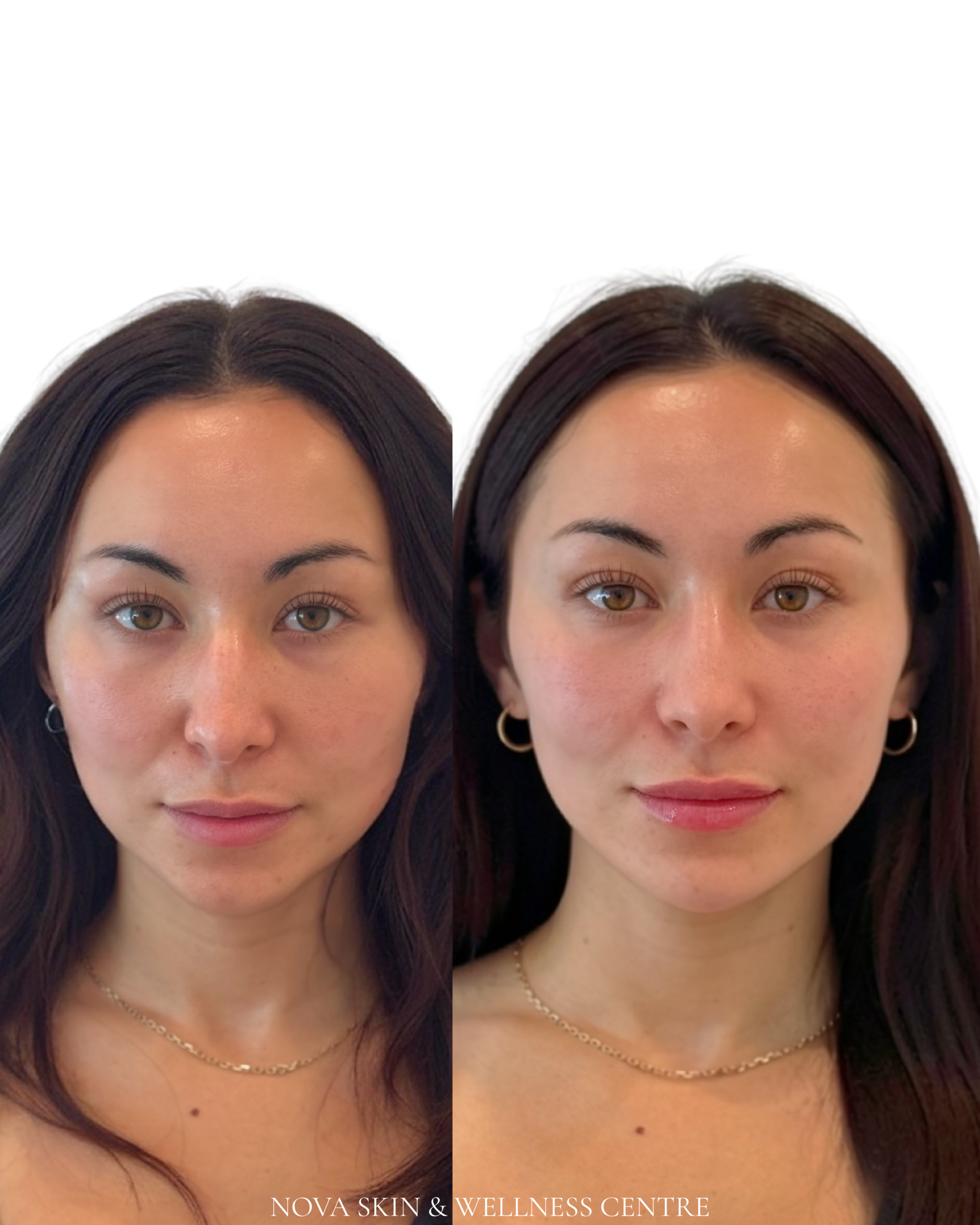 Nova Skin and Wellness Centre before and after results