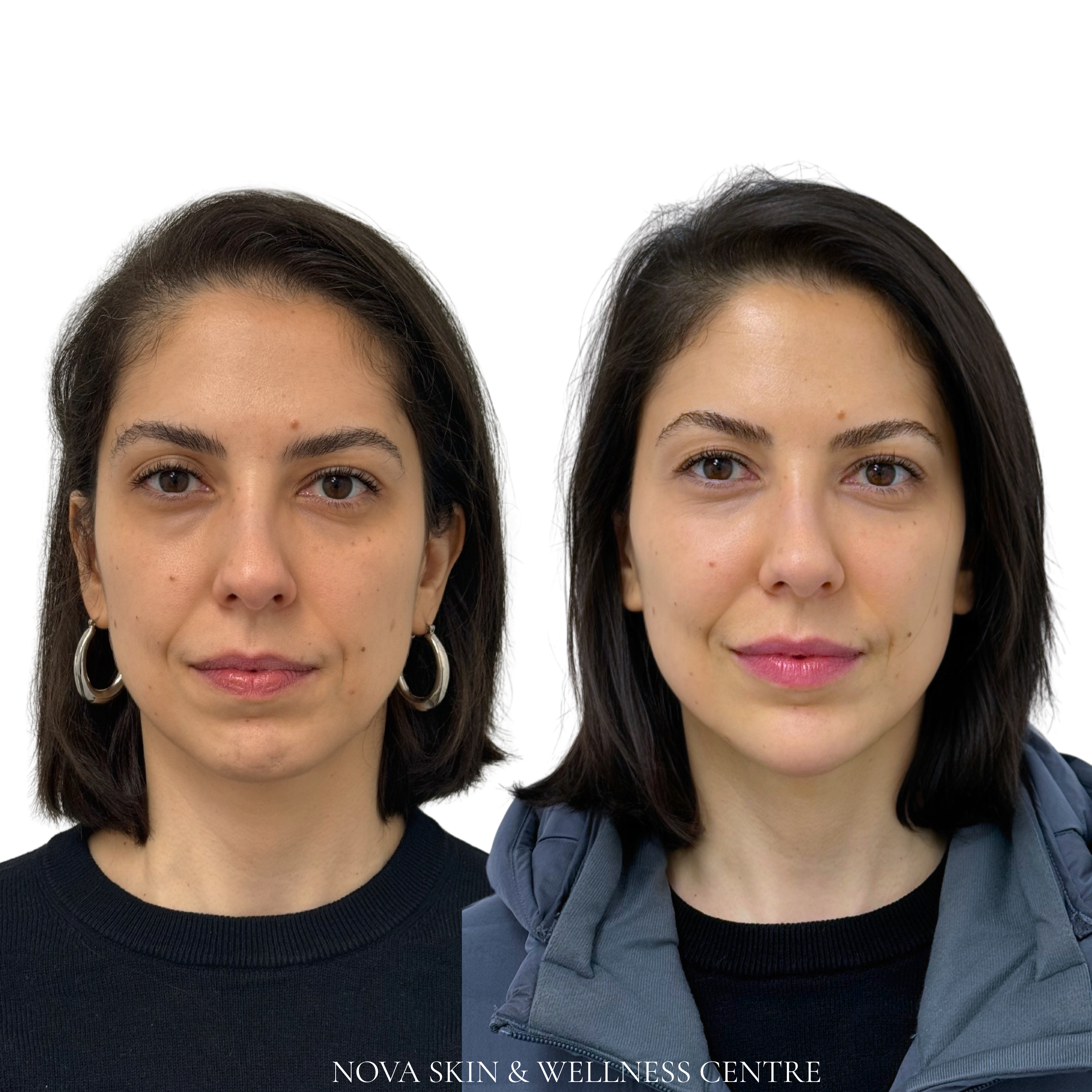 Nova Liquid Lift before and after