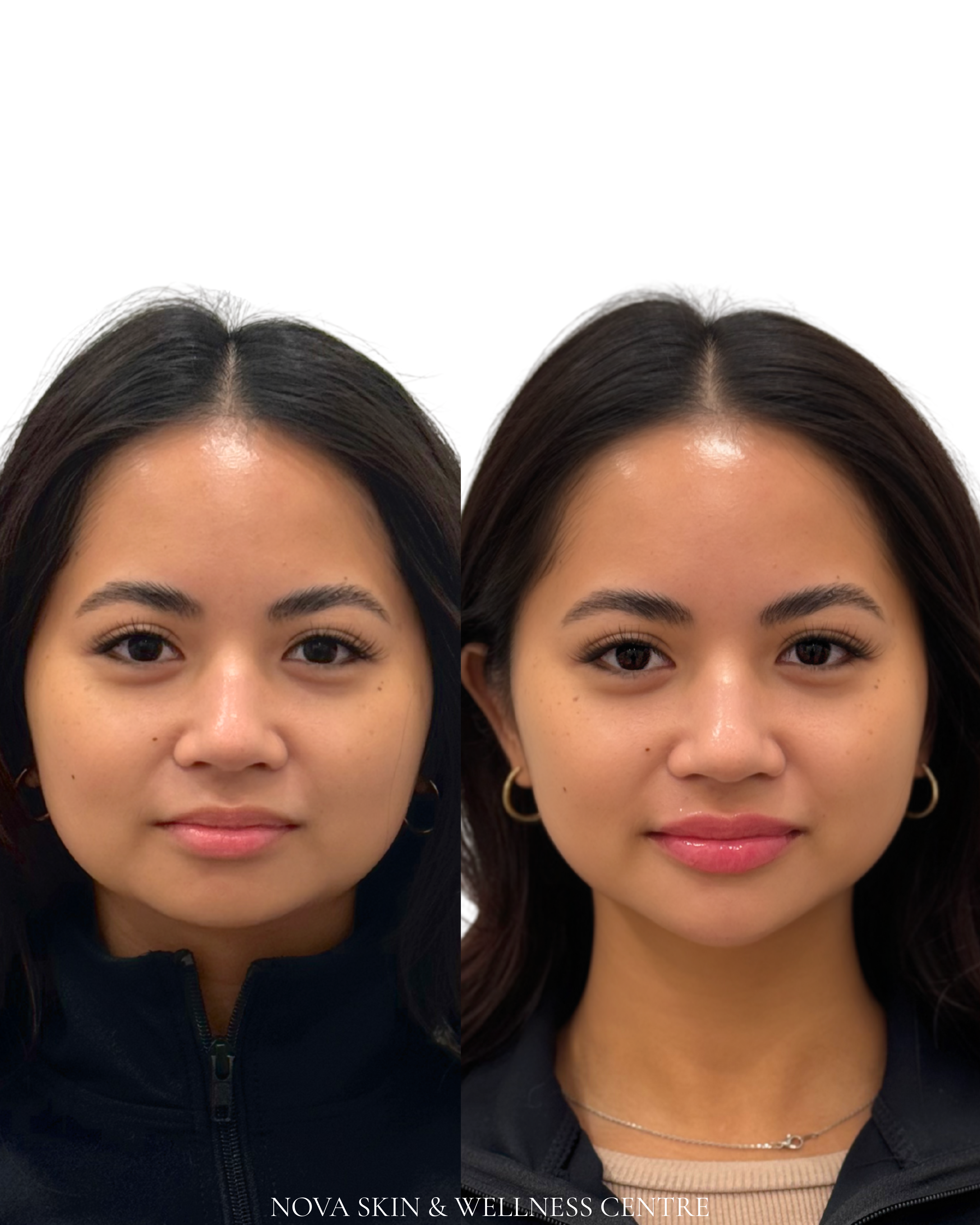 Nova Mini Lift before and after
