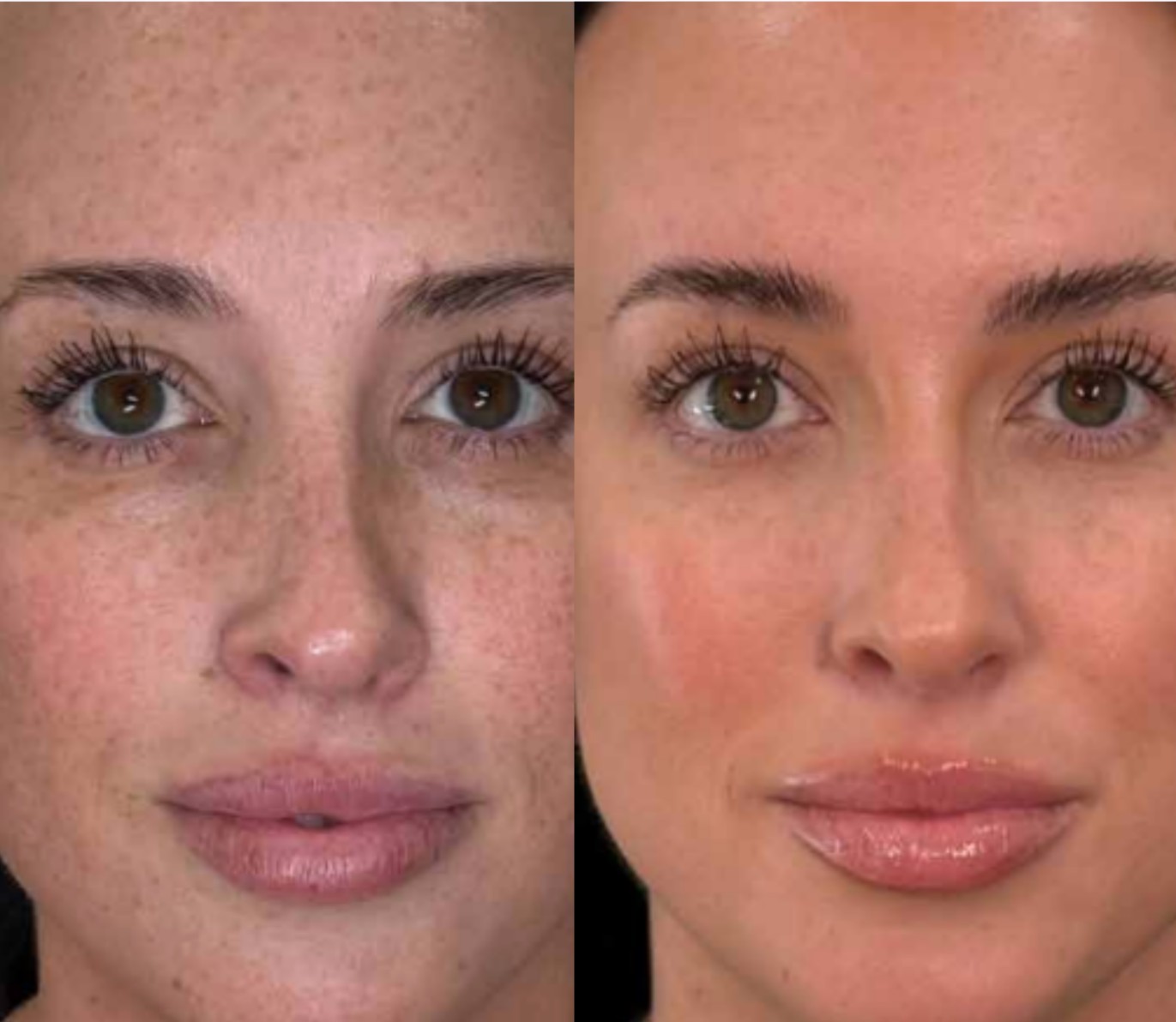 MOXI and BBL HEROic before and after skin resurfacing result