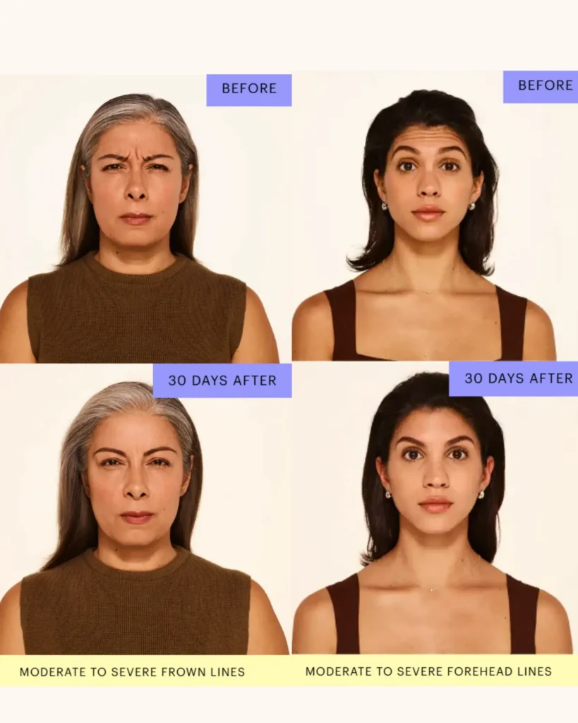 Botox results