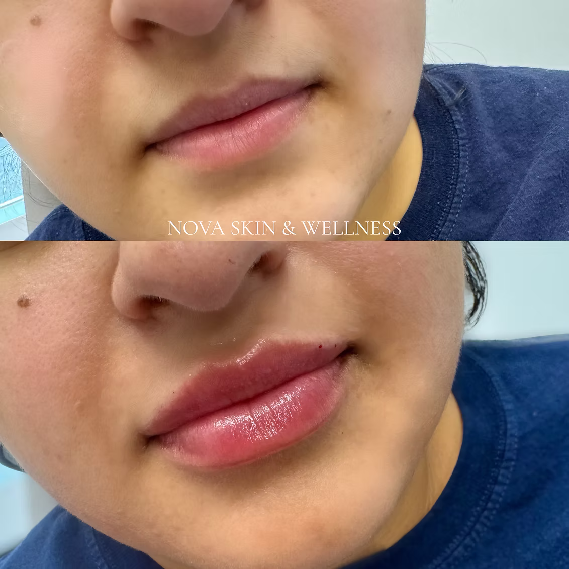 Before and after lip filler treatment