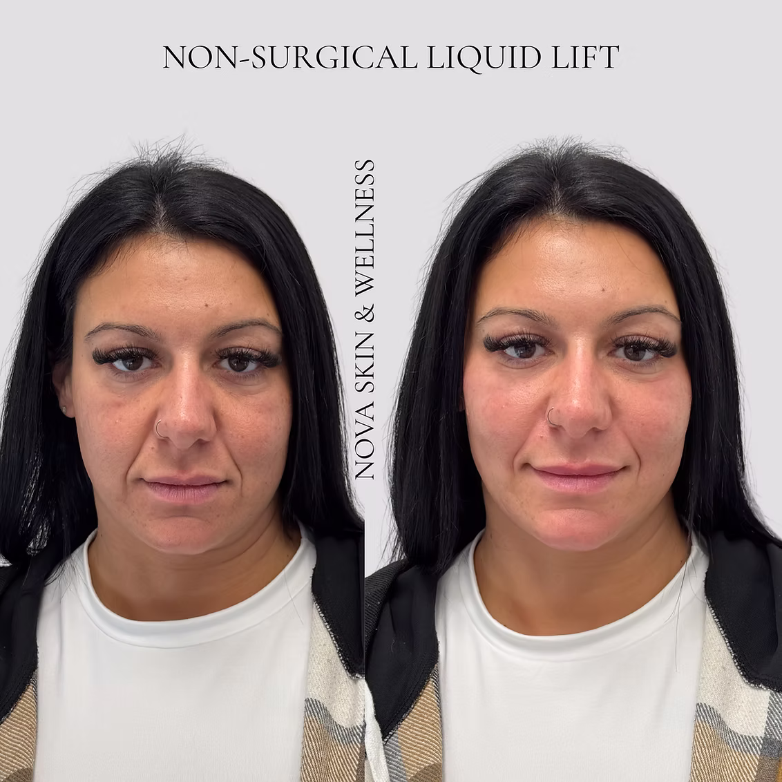 Before and after non-surgical liquid lift