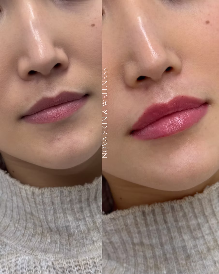 Before and after lip enhancement result
