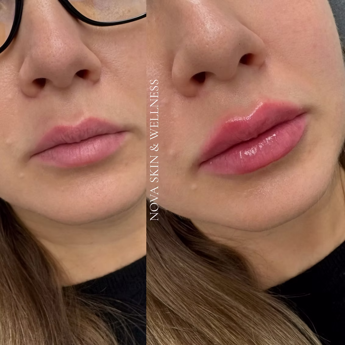 Before and after dermal filler result