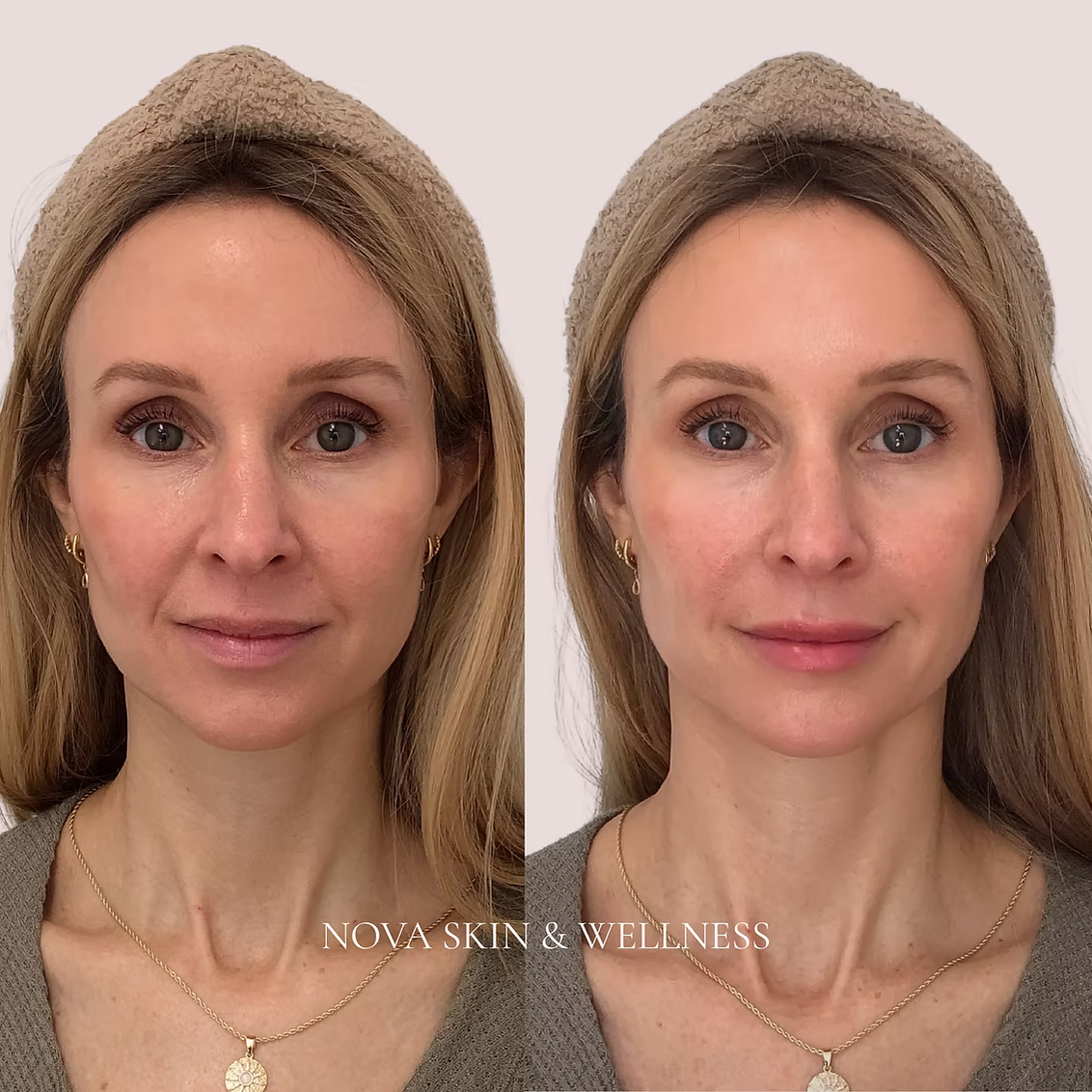 Before and after facial rejuvenation treatment