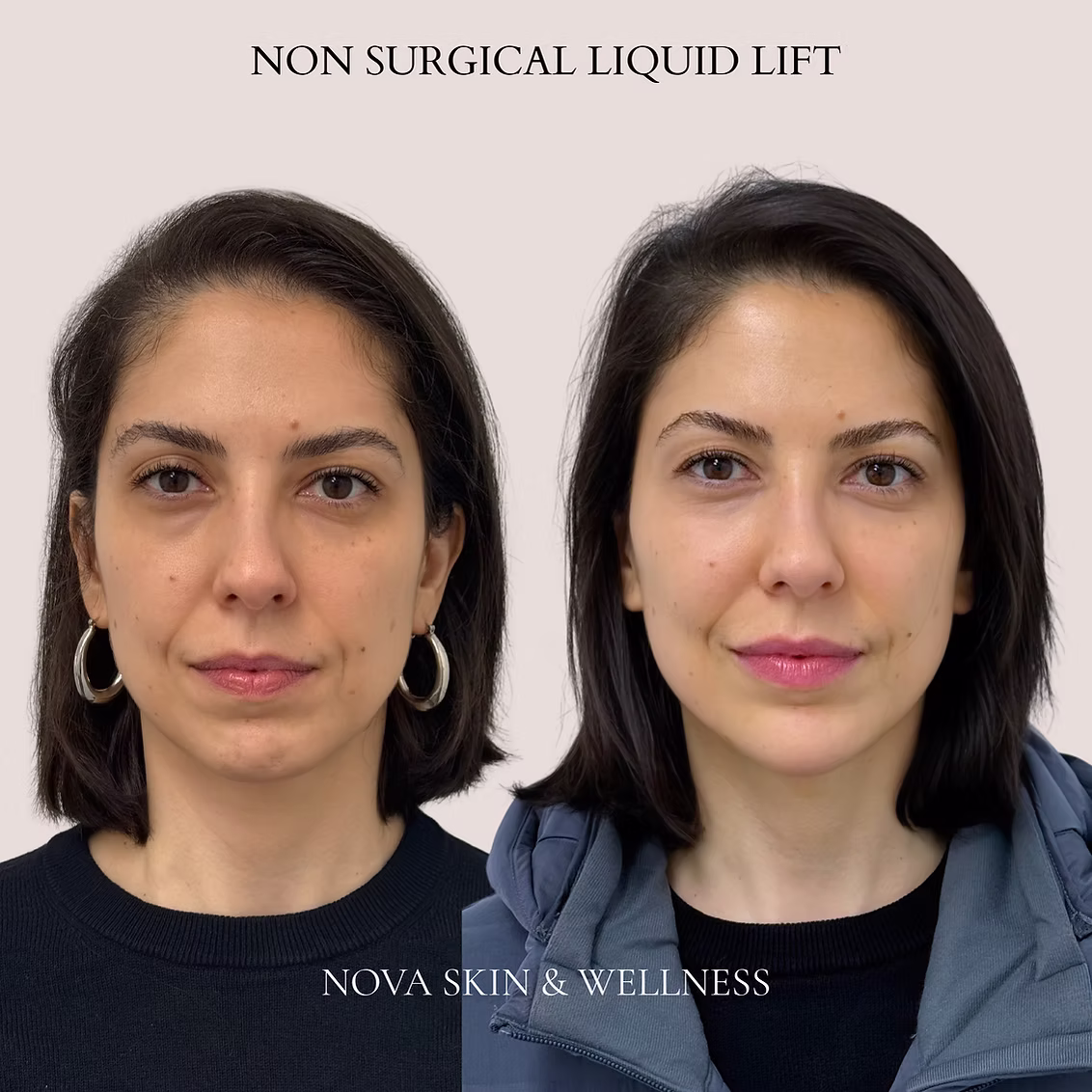 Before and after cosmetic treatment result