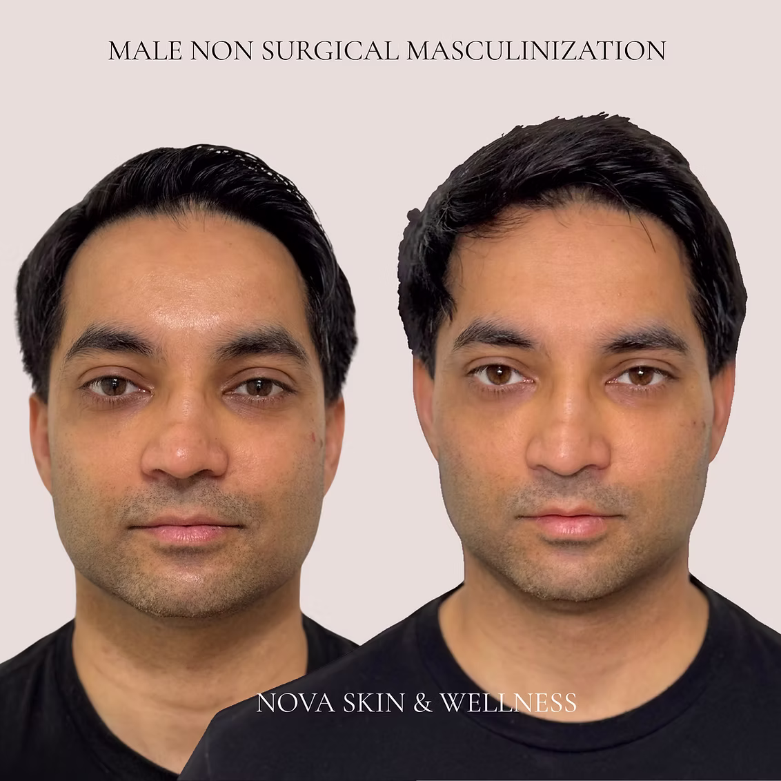 Before and after male facial rejuvenation treatment