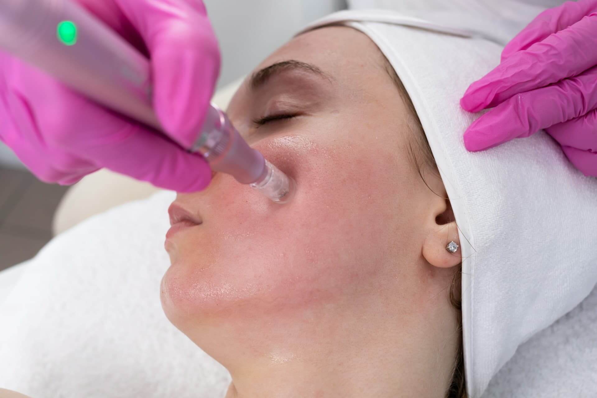 Microneedling process