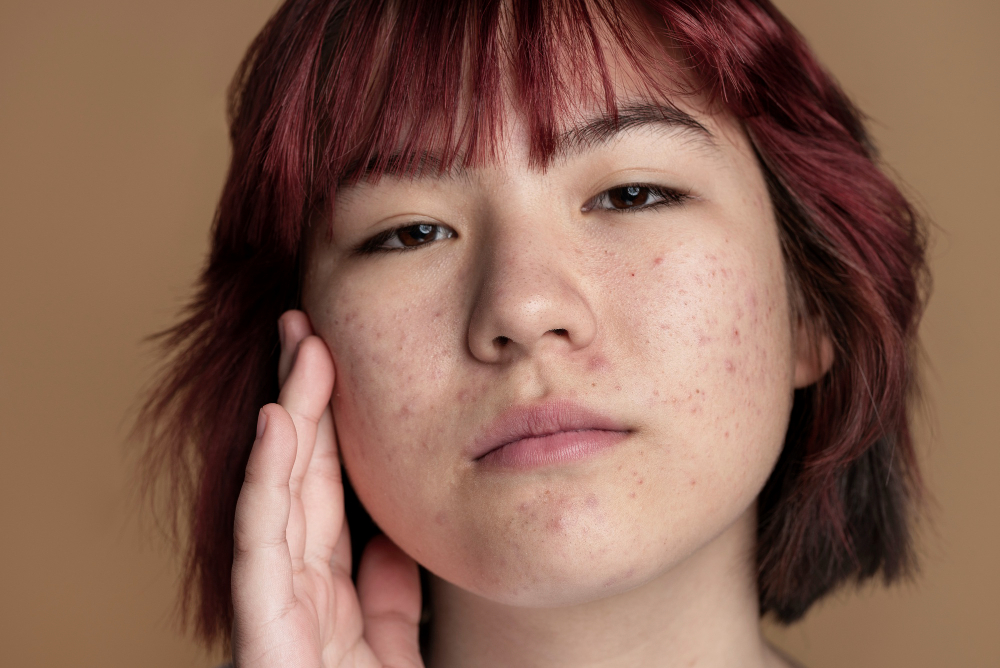Forever Clear Acne Treatment