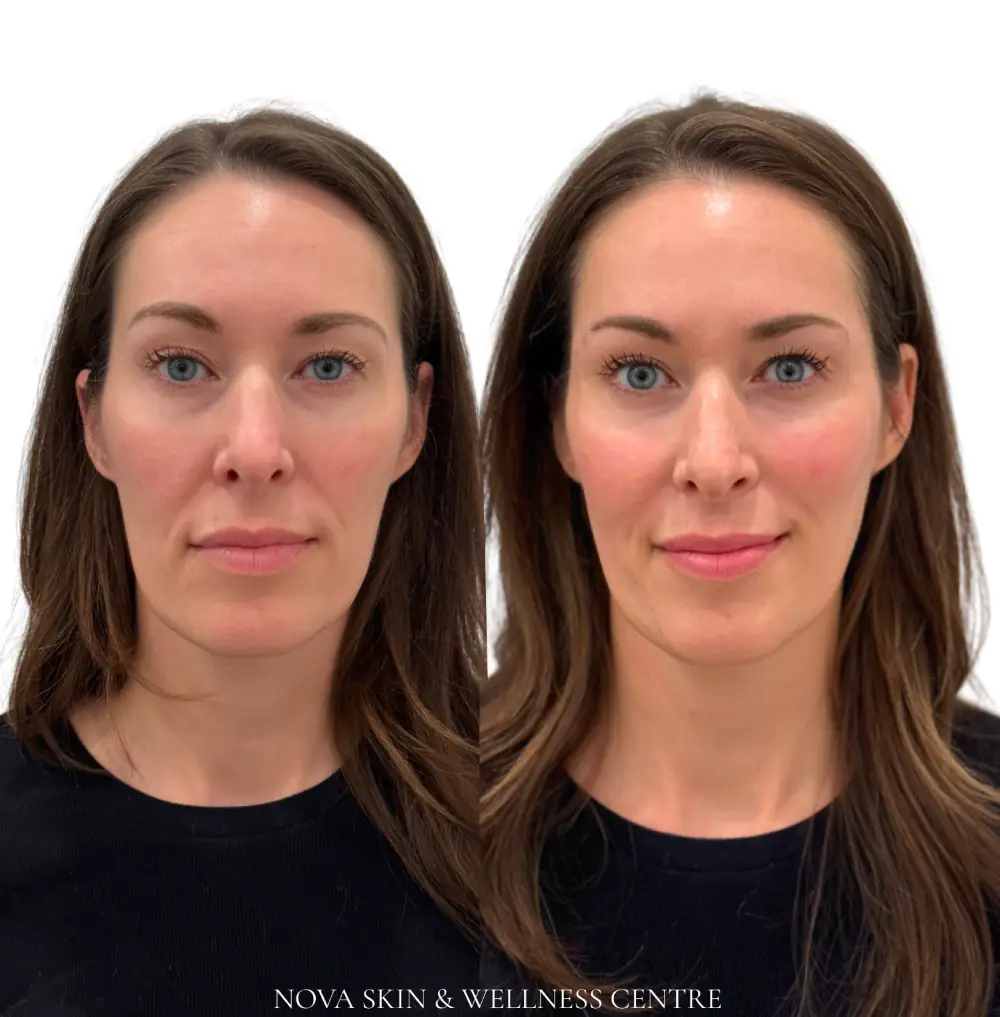 NOVA Liquid Lift treatment at Nova Skin & Wellness Centre