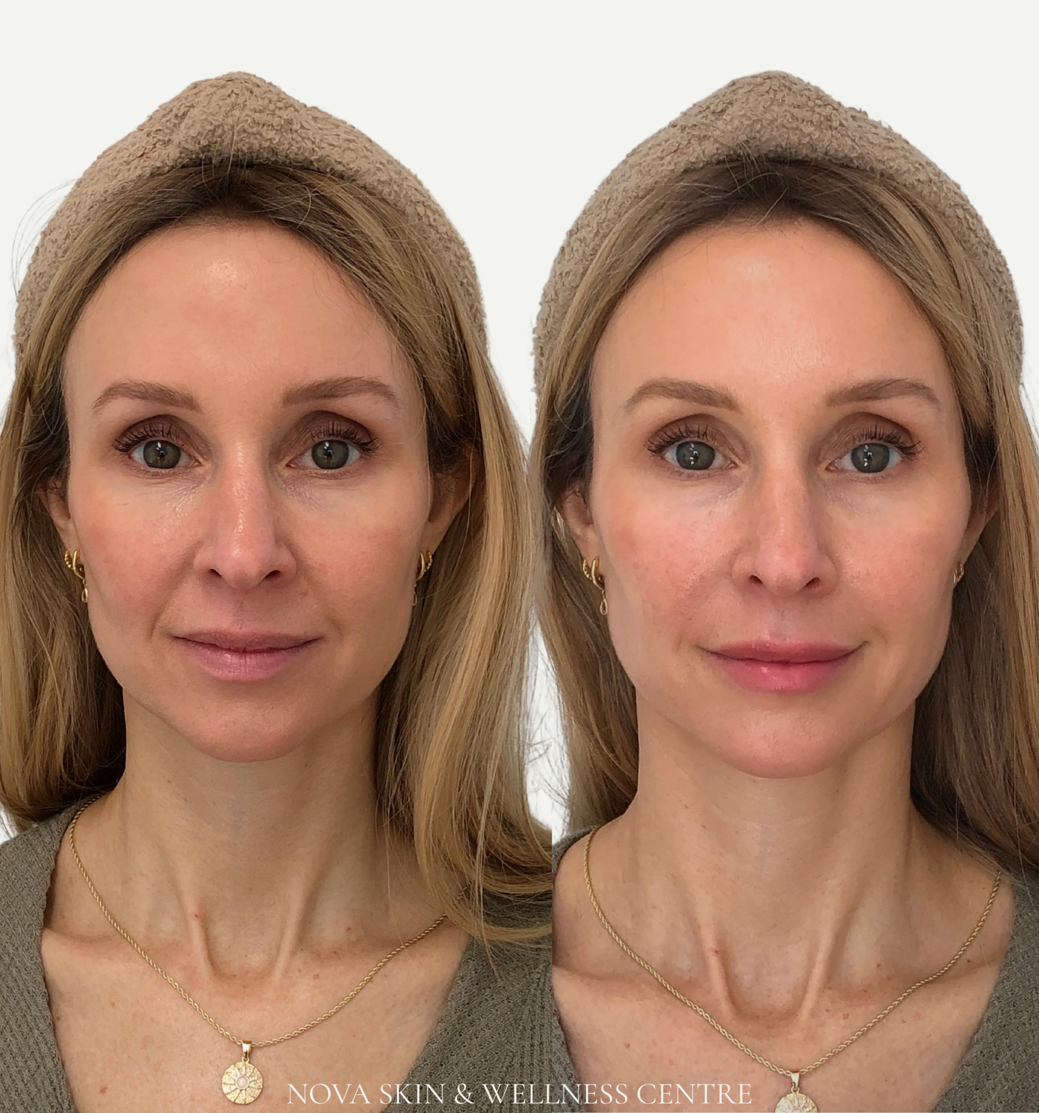 NOVA Mini Lift treatment at Nova Skin & Wellness Centre