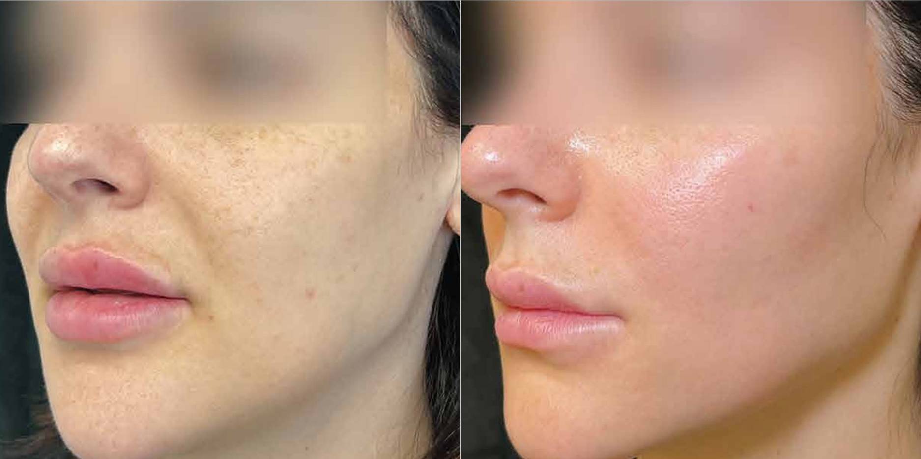 BBL HEROic pigmentation treatment before and after