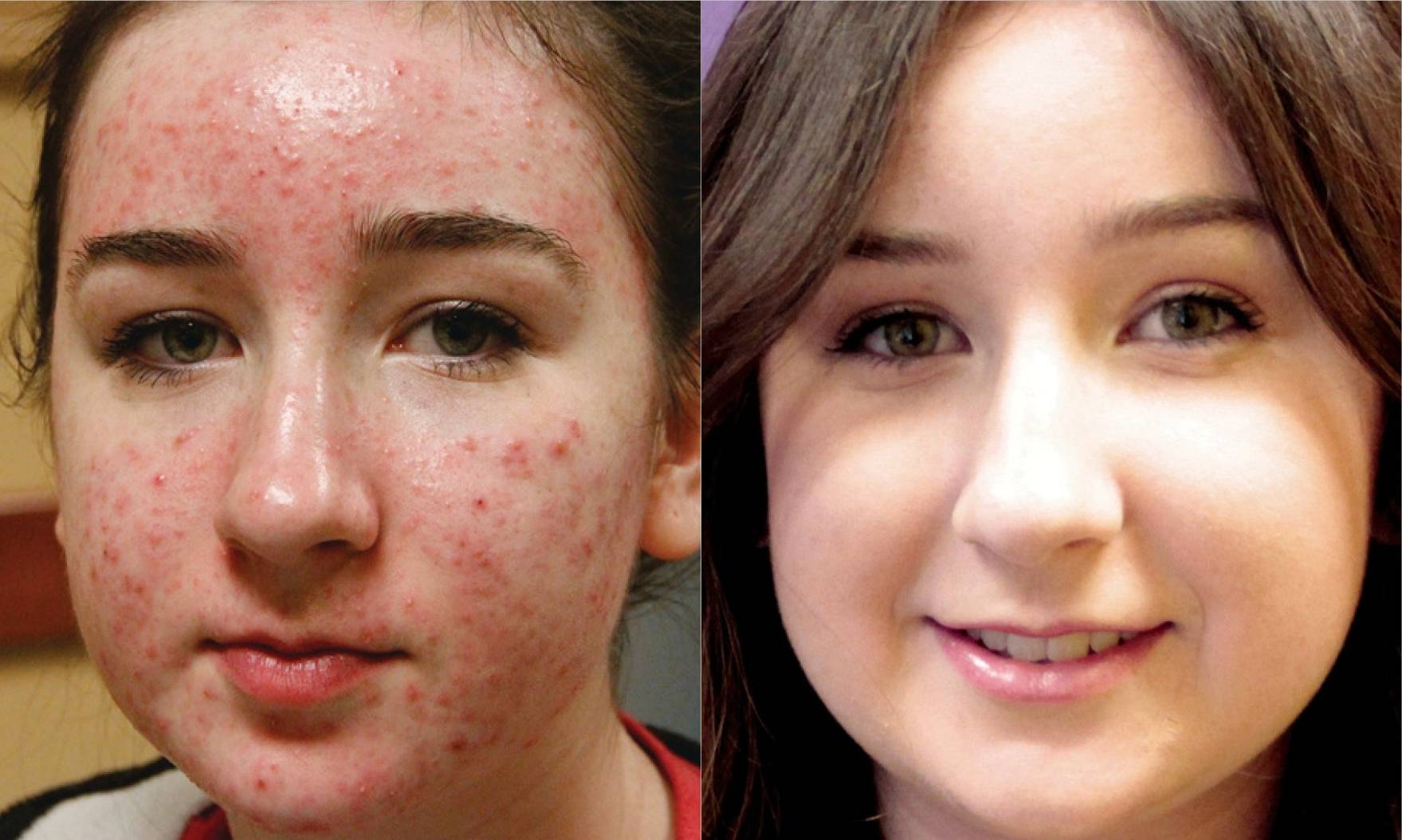 Forever Clear BBL acne treatment results