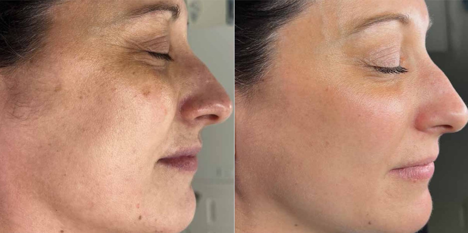 MOXI laser skin resurfacing before and after
