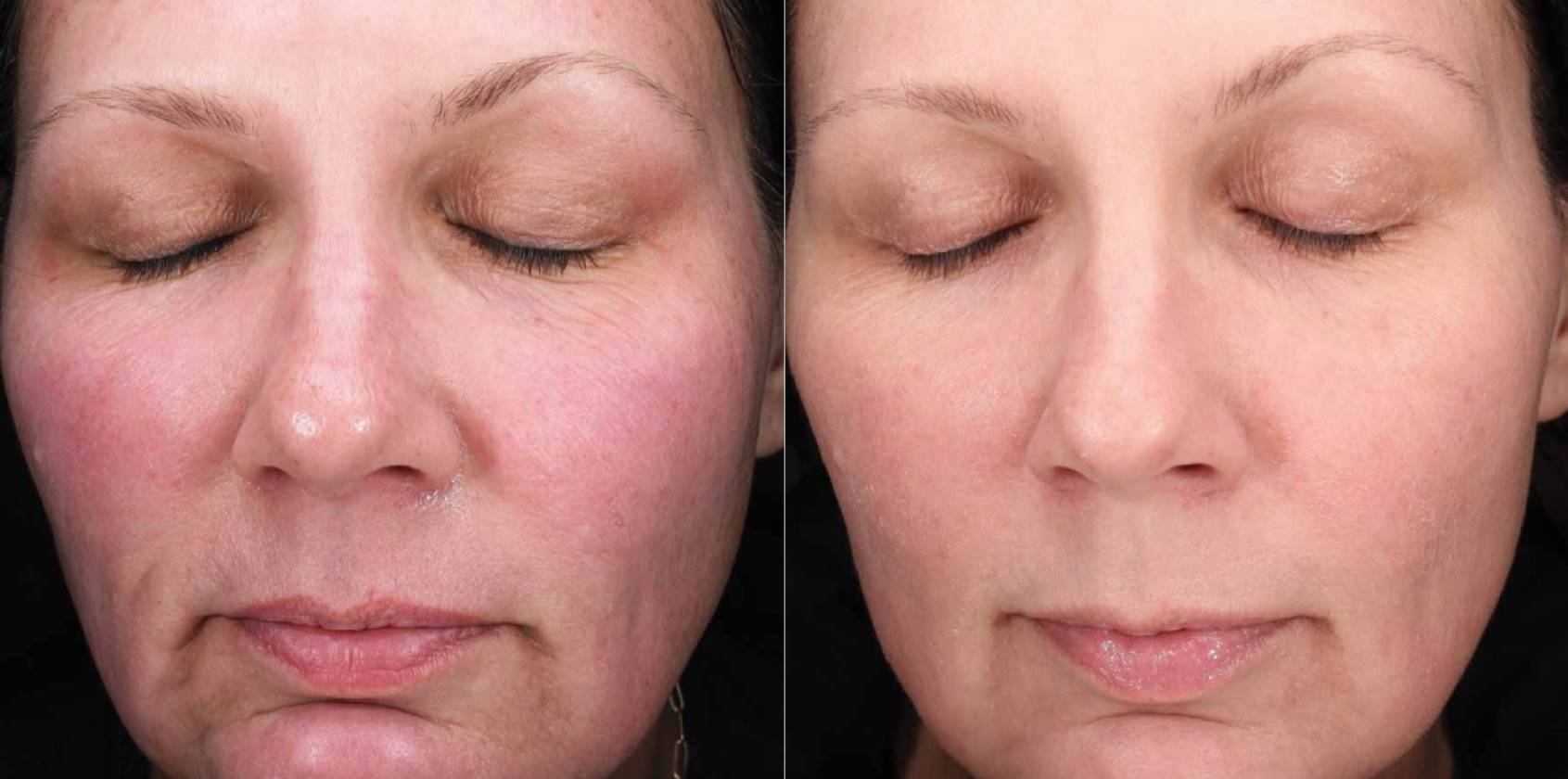 MOXI laser skin resurfacing before and after