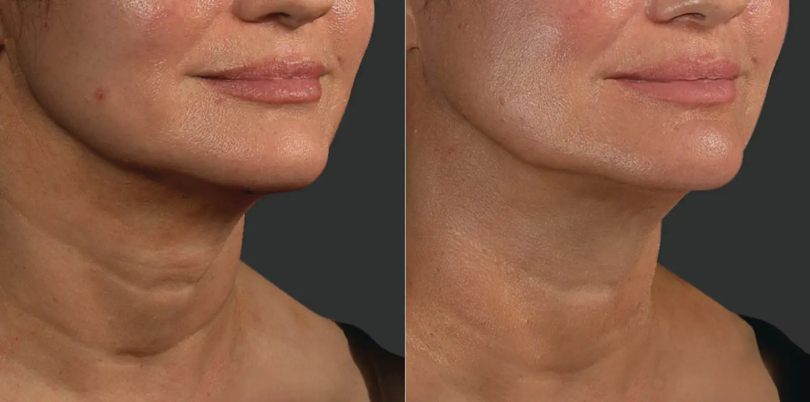SkinTyte skin firming treatment