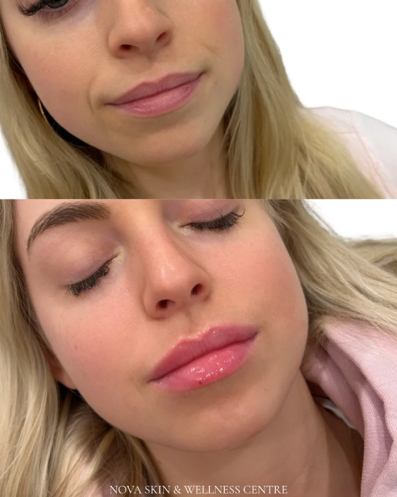 Lip Fillers Results