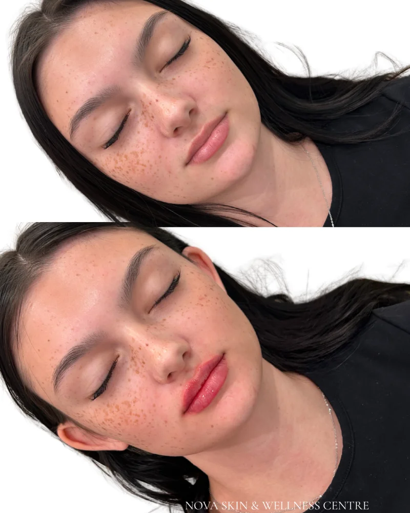 Lip Fillers Results